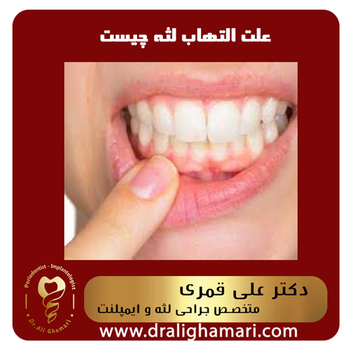 علت التهاب لثه چیست