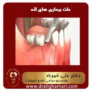 علت بیماری های لثه