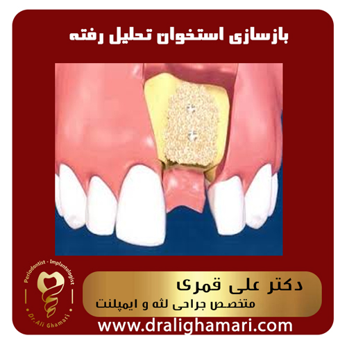 بازسازی استخوان تحلیل رفته