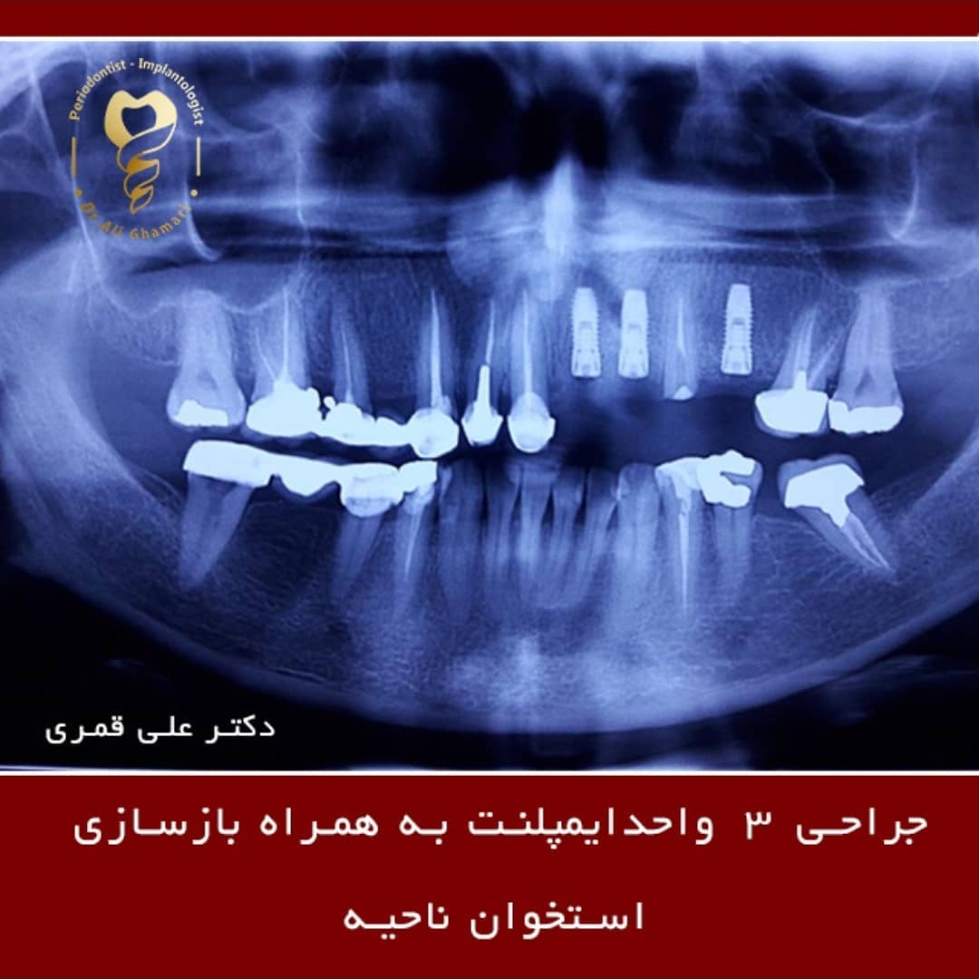 جراحی ایمپلنت دندان