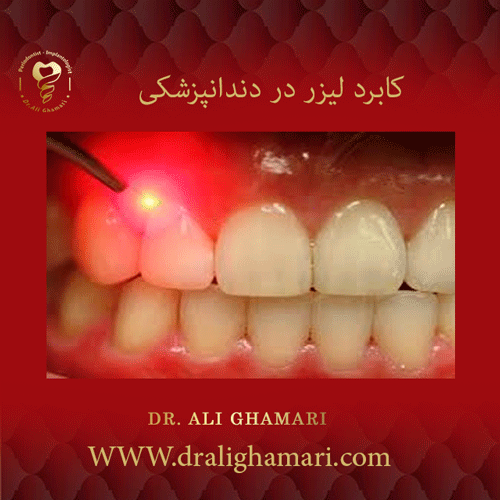 کابرد لیزر در دندانپزشکی