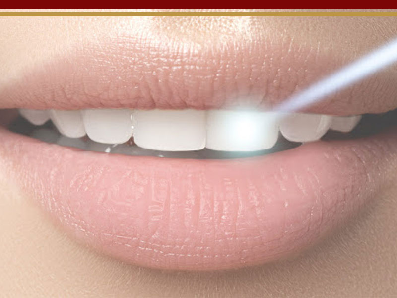 کابرد لیزر در دندانپزشکی