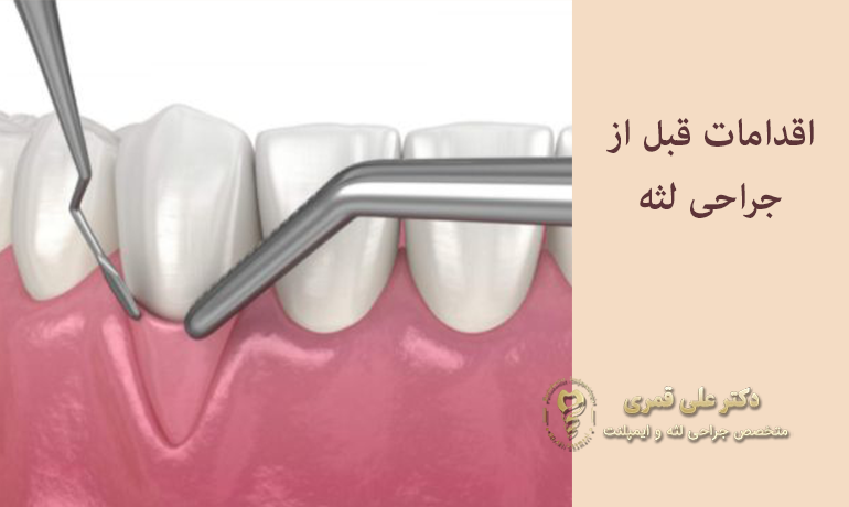 اقدامات قبل از جراحی لثه