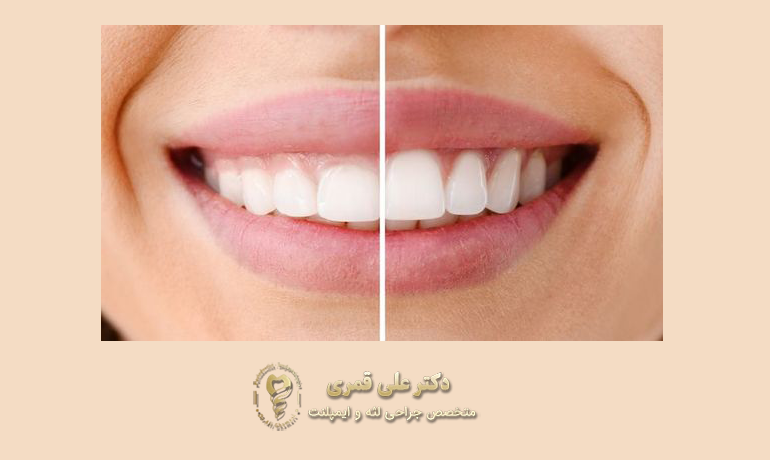 جراحی لثه