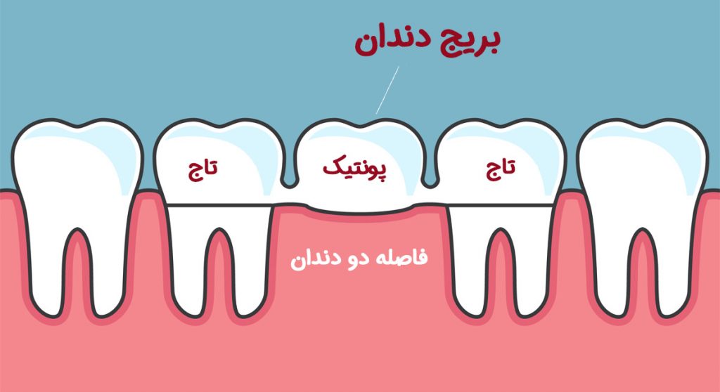 پونتیک دندان