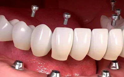 ایمپلنت دندان چیست؟ مراحل، مزایا، عوارض و هزینه کاشت دندان