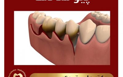 پیوند لثه راهی برای لبخند زیباتر