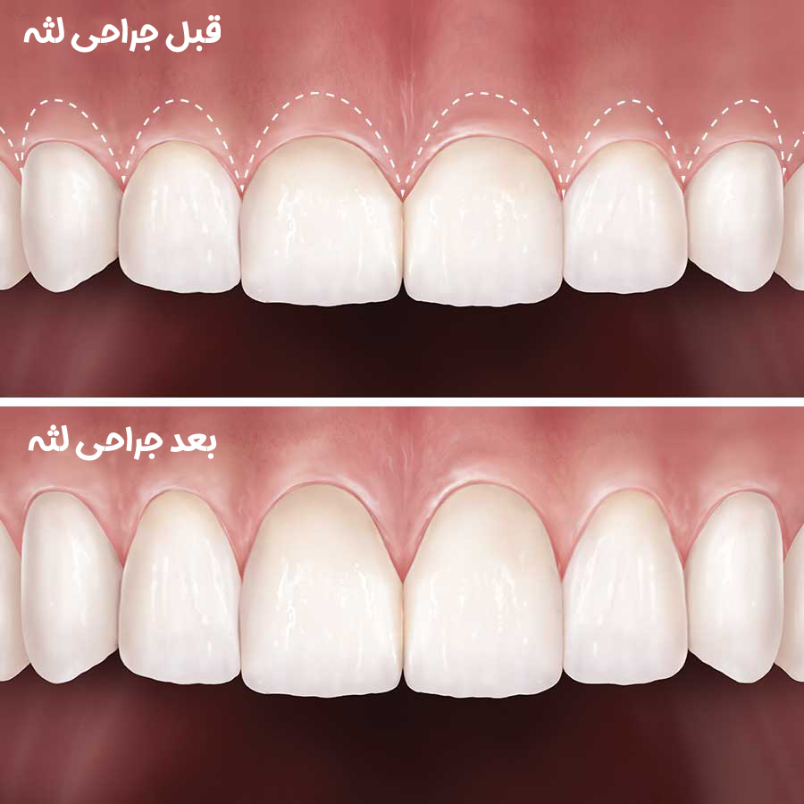 قبل و بعد از جراحی لثه