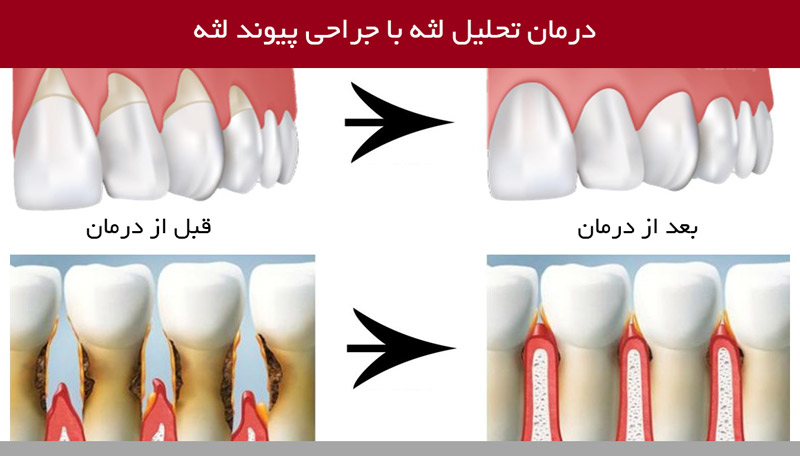 درمان تحلیل لثه