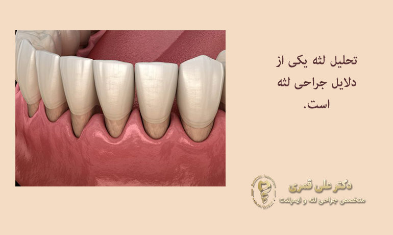 دلایل جراحی لثه