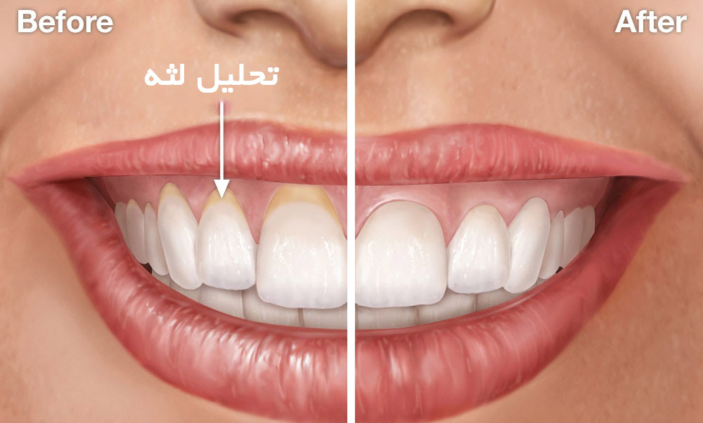 قبل و بعد درمان تحلیل لثه