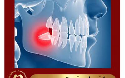 دندان نهفته چیست و چه عوارضی دارد؟