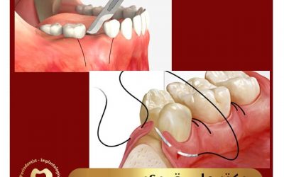 با جراحی لثه و روش های آن بیشتر آشنا شویم