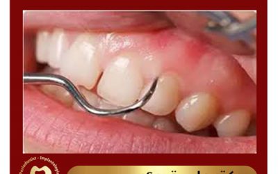 دلایل جراحی لثه