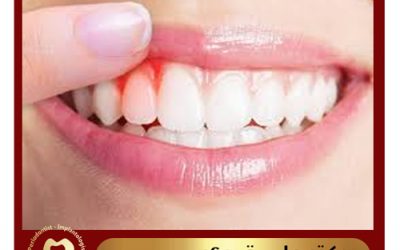 افزایش طول تاج دندان چیست