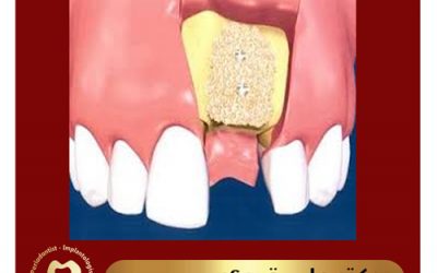 بازسازی استخوان تحلیل رفته