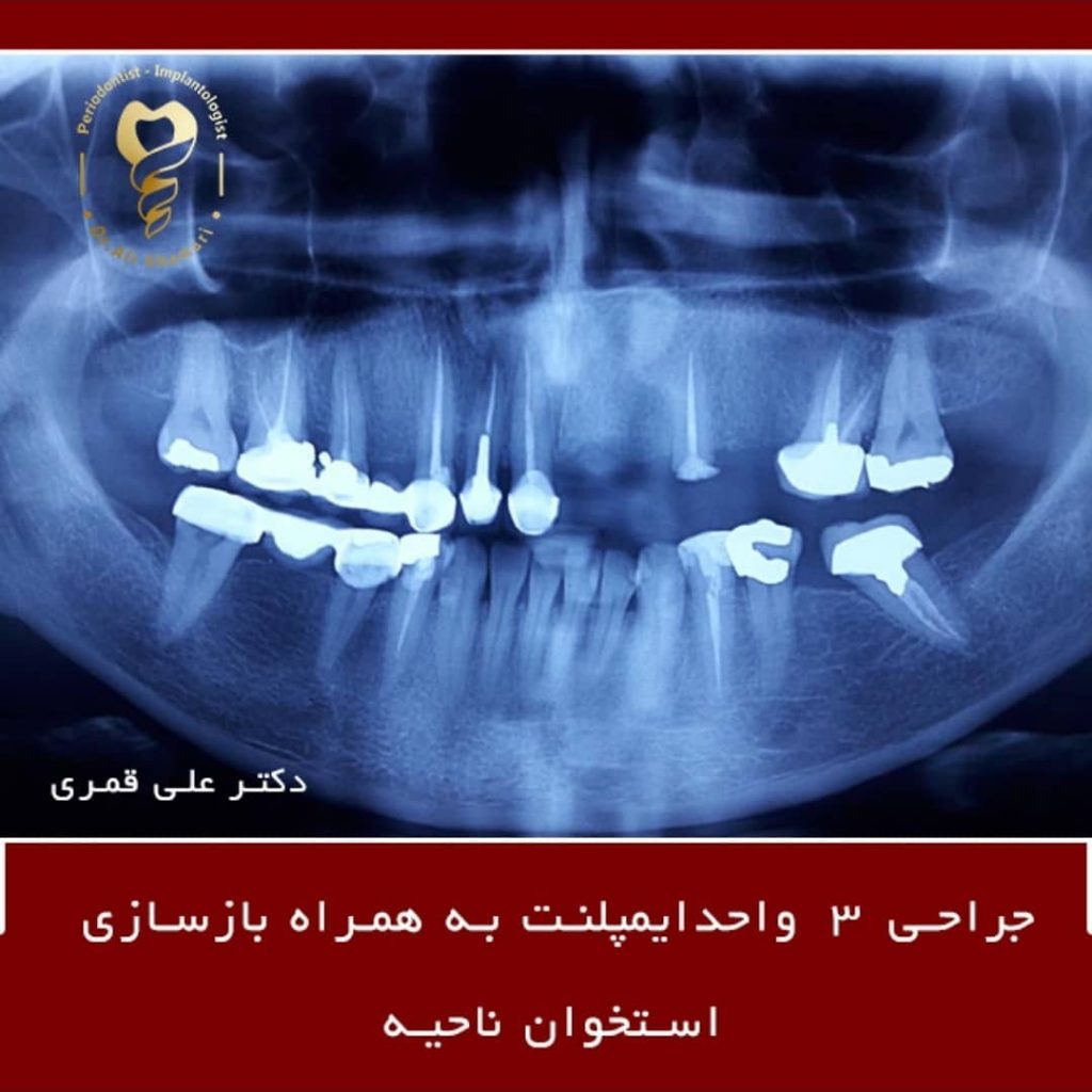 ایمپلنت دندان