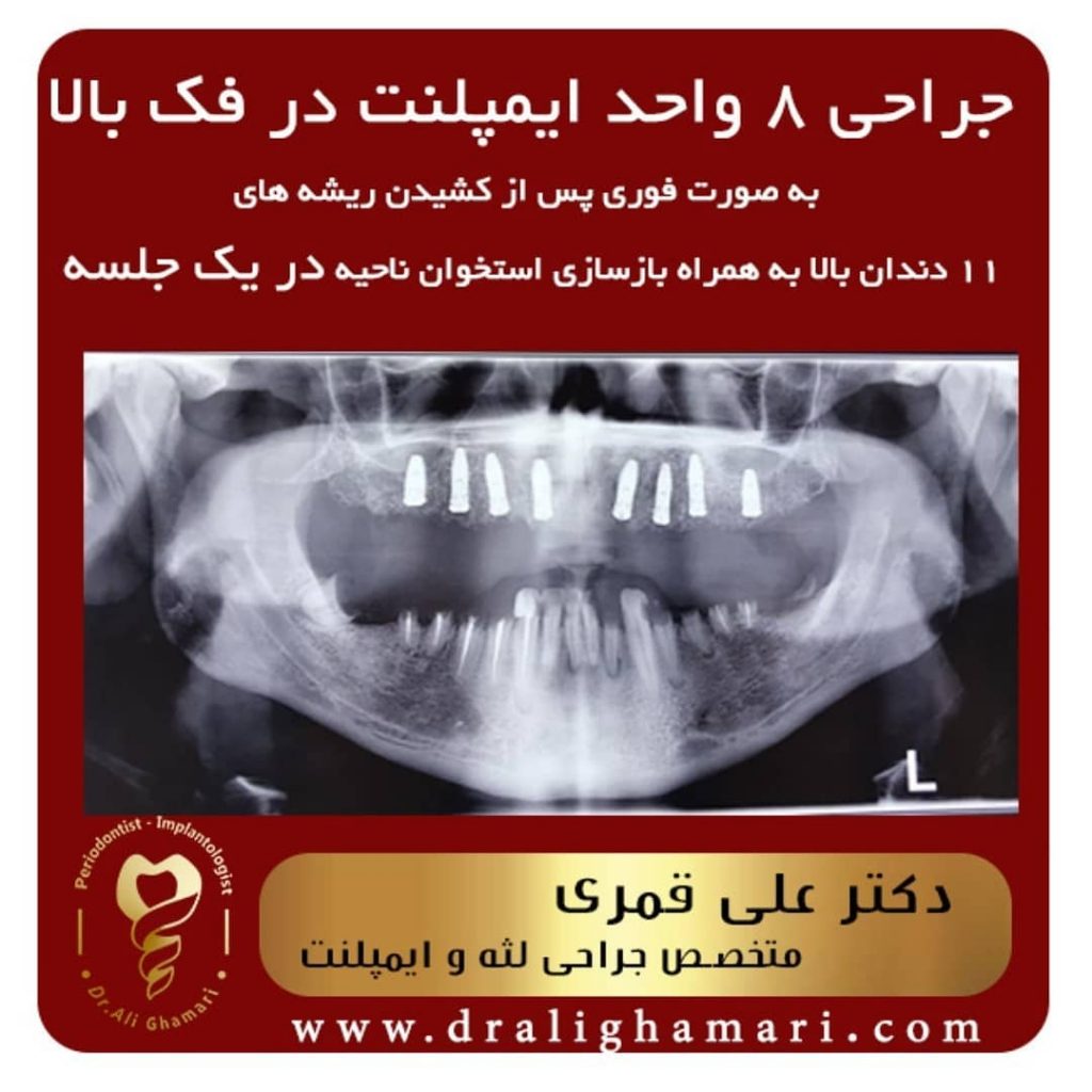 جراحی ایمپلنت فوری