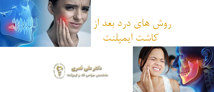 روش های کاهش درد بعد از کاشت ایمپلنت
