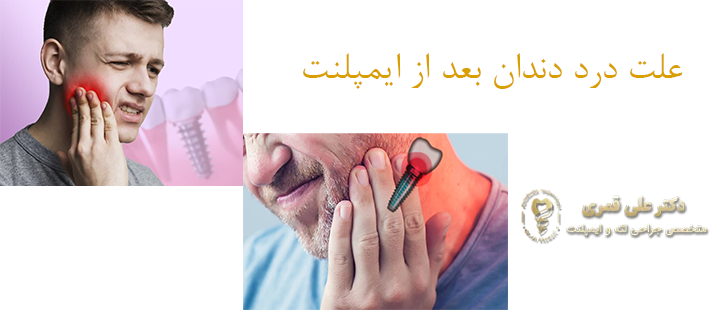 علت درد دندان بعد از ایمپلنت 
