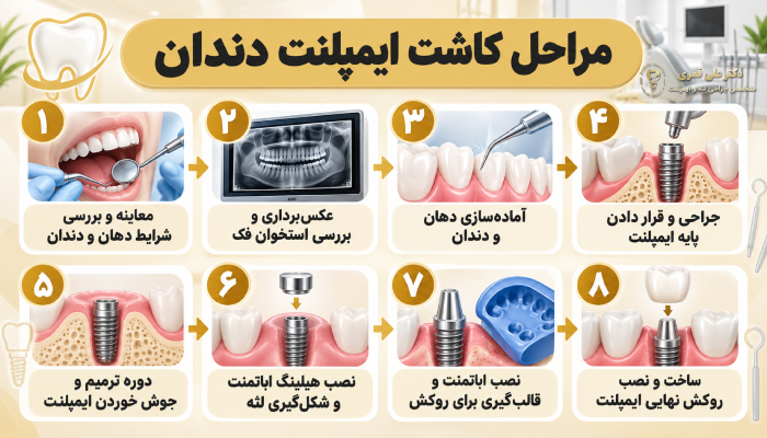 مراحل کاشت ایمپلنت دندان به ترتیب چیست؟