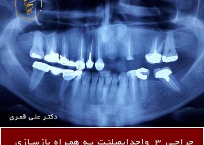 ایمپلنت دندان