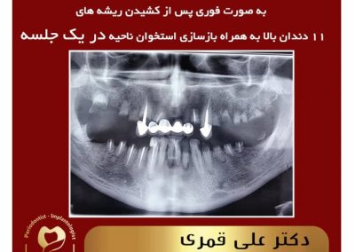 ایمپلنت فوری