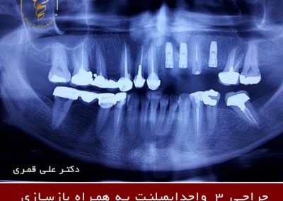 جراحی ایمپلنت دندان