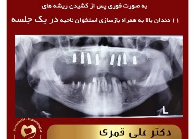 جراحی ایمپلنت فوری