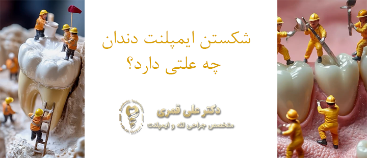 شکستن ایمپلنت دندان چه علتی دارد؟