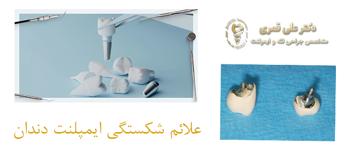 علائم شکسته شدن ایمپلنت دندان 