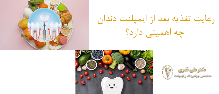 اهمیت رعایت تغذیه بعد از ایمپلنت دندان