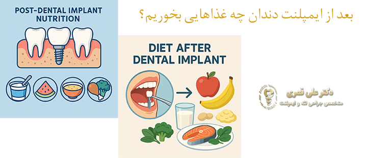 بعد از ایمپلنت چه غذاهایی بخوریم؟