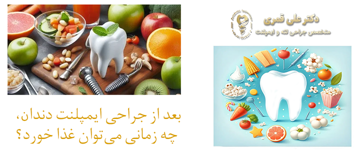زمان مناسب غذا خوردن بعد از ایمپلنت دندان