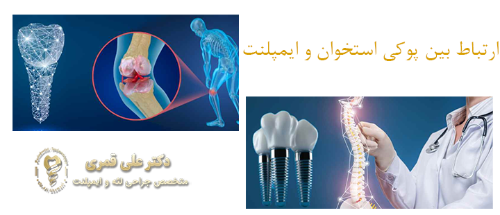 ارتباط بین پوکی استخوان و ابمپلنت 