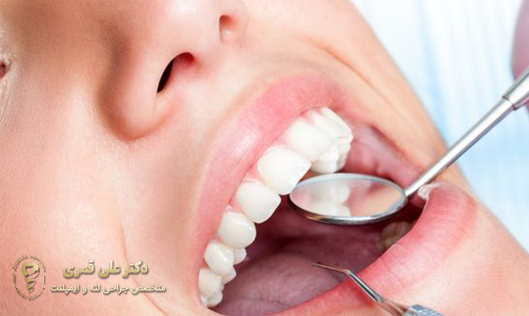 نگهداری صحیح از ایمپلنت
