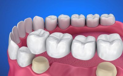 بریج دندان چیست و چه مزایایی دارد؟