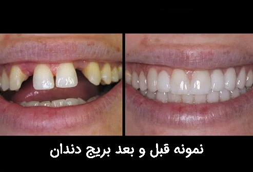 قبل و بعد بریج دندان
