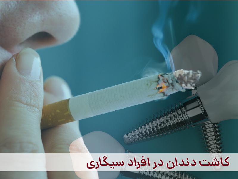 کاشت دندان در افراد سیگاری
