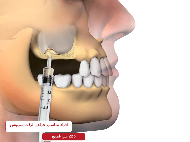 افراد مناسب جراحی لیفت سینوس