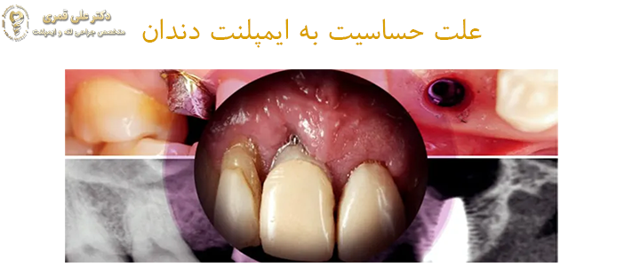 علت حساسیت به ایمپلنت دندان 