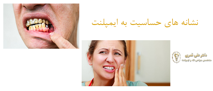 نشانه های حساسیت به ایمپلنت دندان 