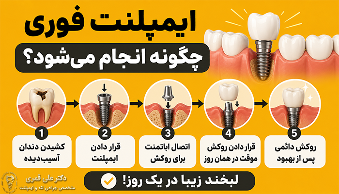 ایمپلنت فوری چگونه انجام میشود؟