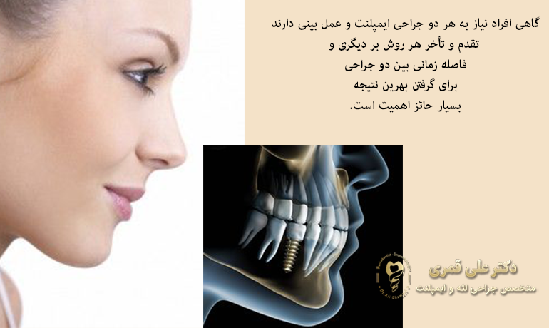 اول ایمپلنت کنم یا عمل بینی