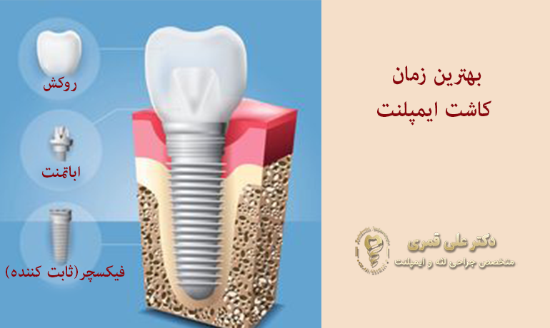 بهترین زمان کاشت ایمپلنت
