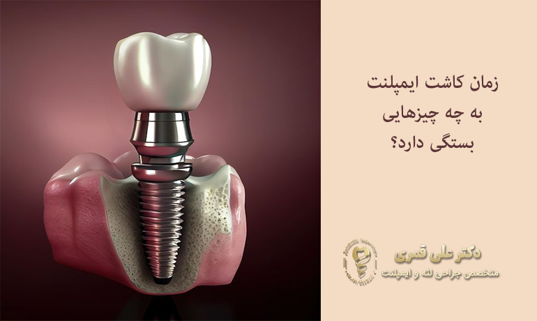 زمان کاشت ایمپلنت به چه چیزهایی بستگی دارد؟