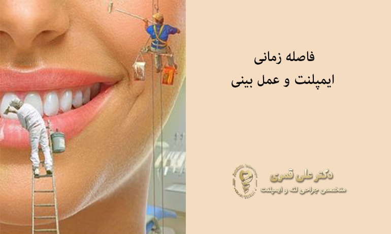 فاصله زمانی بین ایمپلنت و عمل بینی