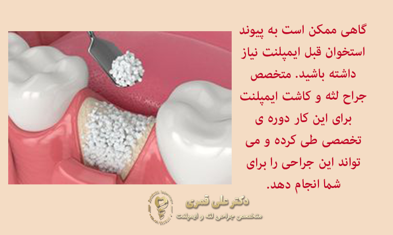 فاصله زمانی بین کشیدن دندان و کاشت ایمپلنت
