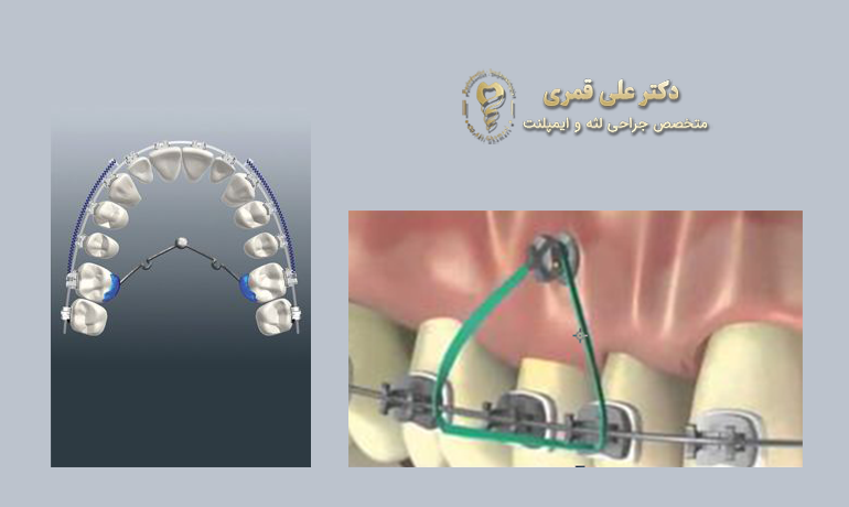 مینی ایمپلنت برای ارتودنسی