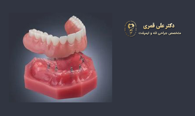 مینی ایمپلنت برای ثابت کردن دندان مصنوعی